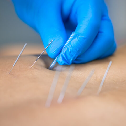 Acupuncture treatment being applied to the lower back for pain relief