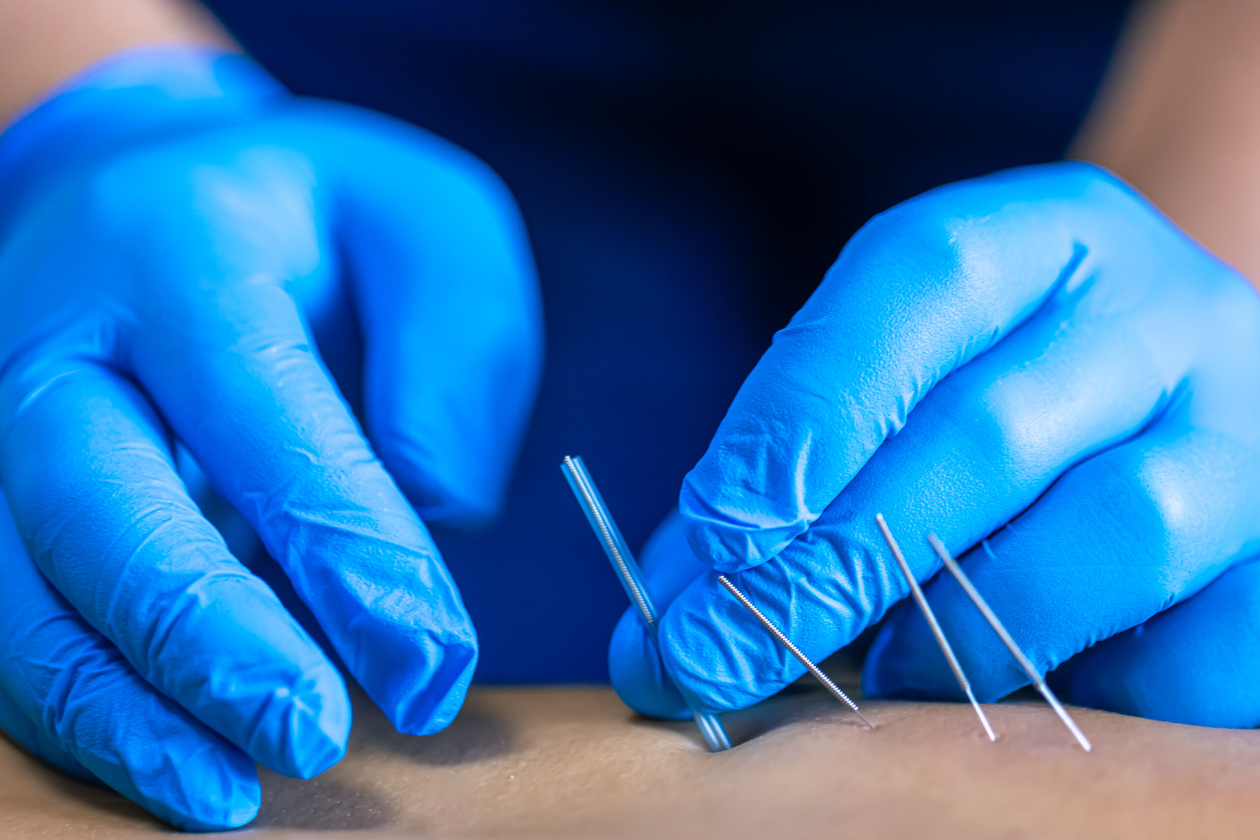 Professional applying acupuncture needles for pain relief therapy