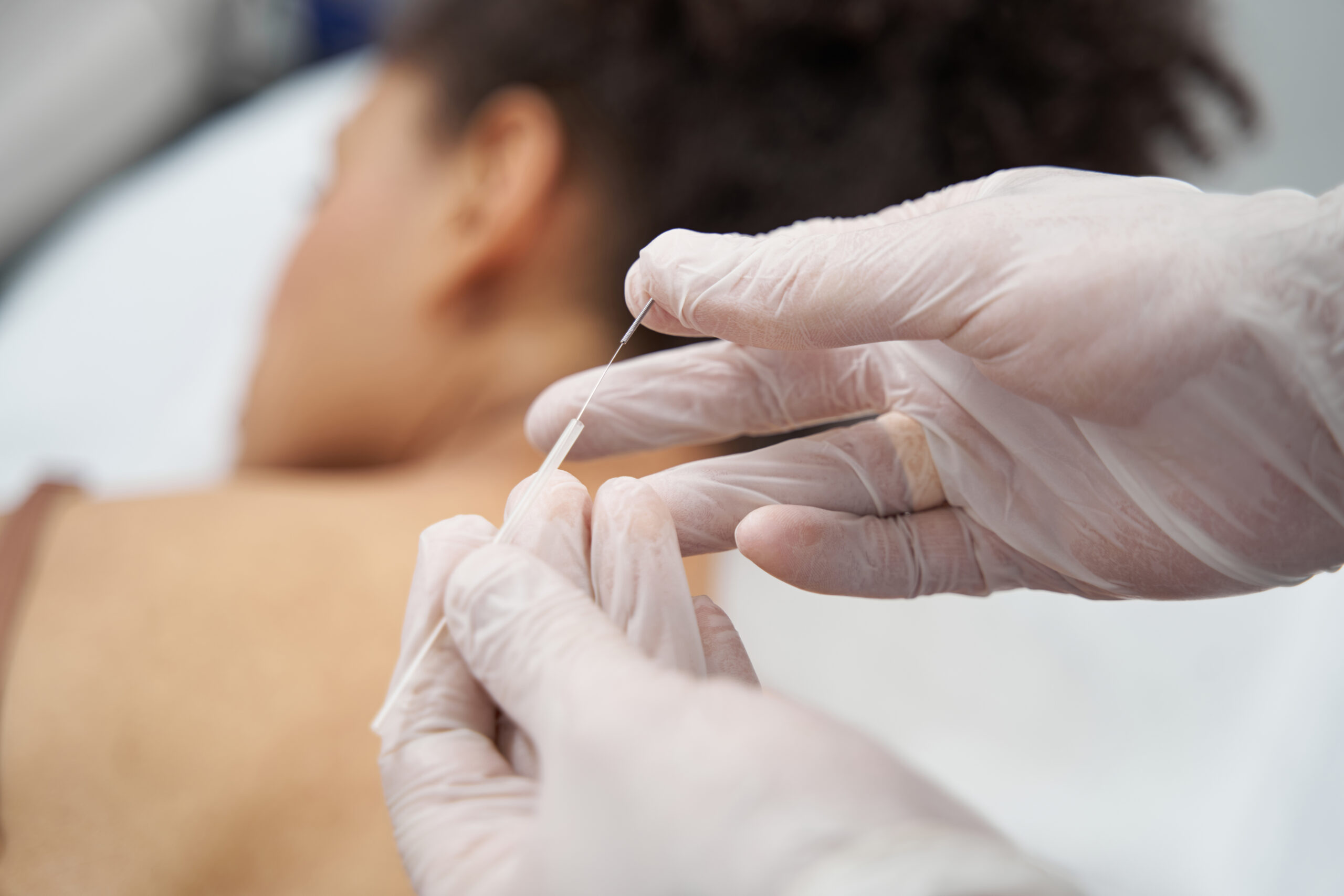 Acupuncturist preparing needle for a pain relief therapy session
