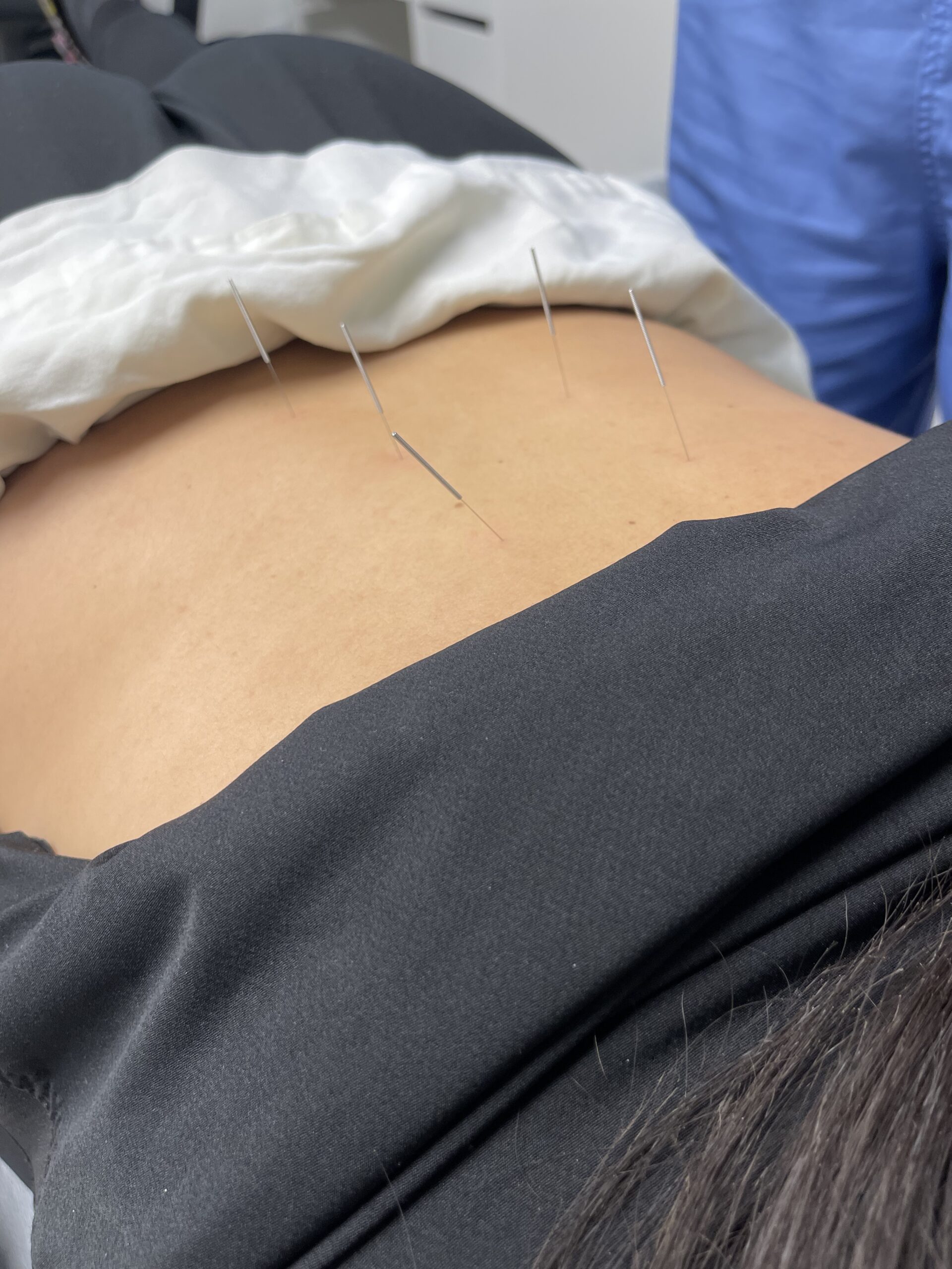Acupuncture - MedAmerica Physical Therapy, Occupational Therapy ...