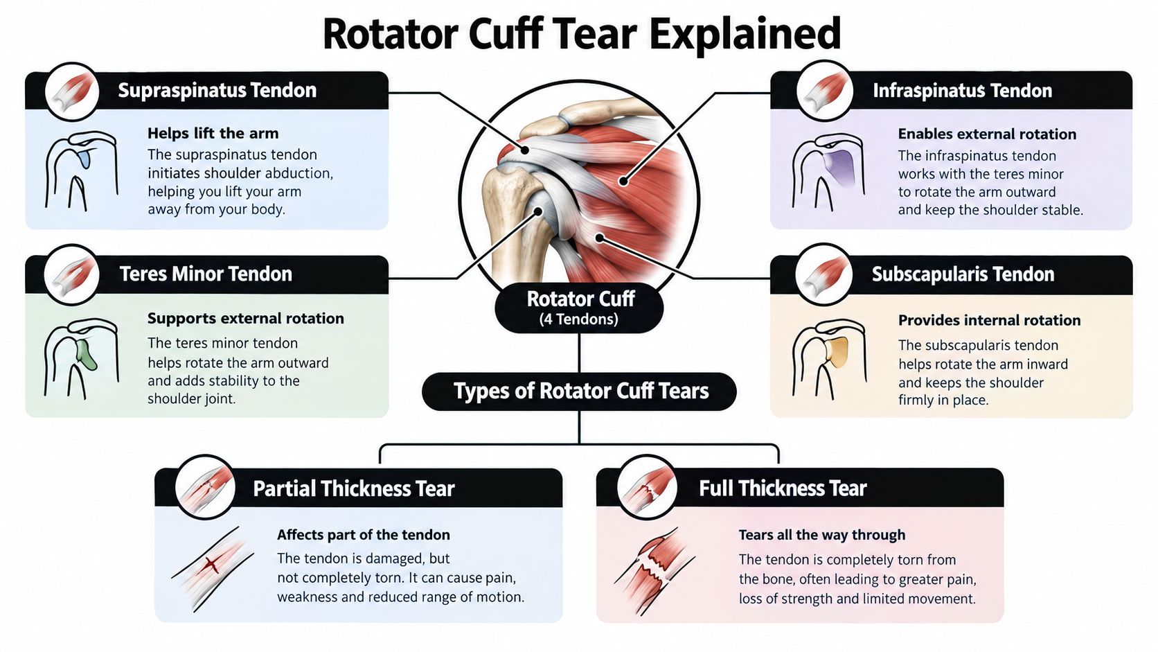 A diagram explaining rotator cuff anatomy, including its four tendons and the two types of tears.